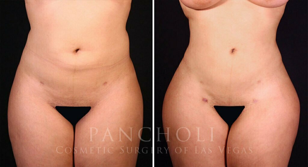 liposuction-brazilian-butt-lift-21374-a