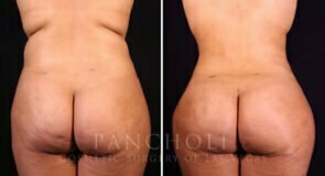 liposuction-brazilian-butt-lift-21374-d
