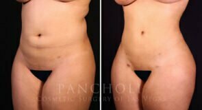 liposuction-brazilian-butt-lift-21374-lb