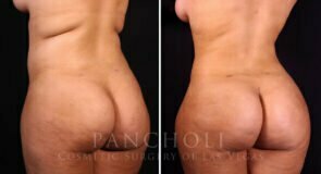 liposuction-brazilian-butt-lift-21374-ldc