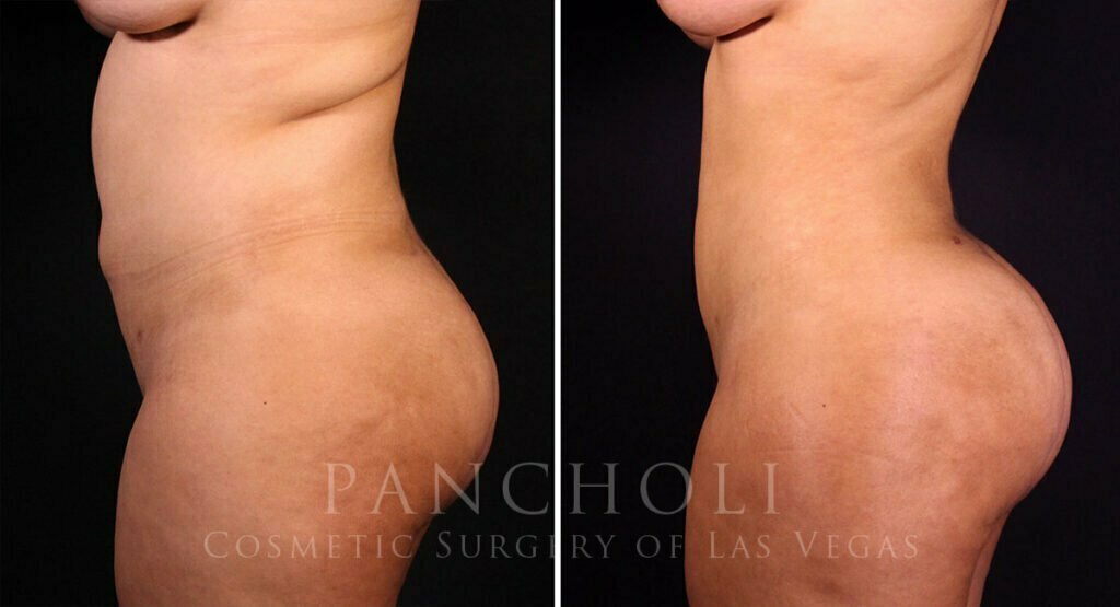 liposuction-brazilian-butt-lift-21374-ls