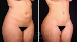 liposuction-brazilian-butt-lift-21374-rb