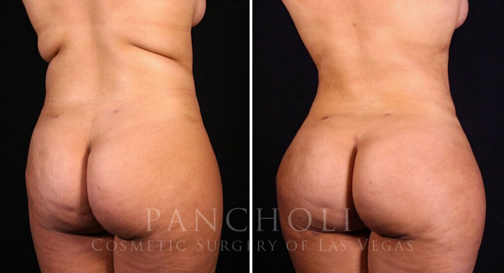liposuction-brazilian-butt-lift-21374-rdc