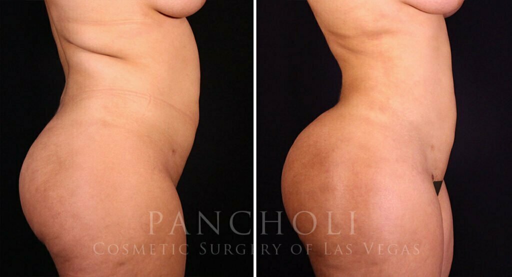 liposuction-brazilian-butt-lift-21374-rs