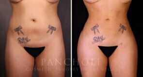 liposuction-brazillian-butt-lift-21357-a