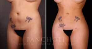 liposuction-brazillian-butt-lift-21357-lb