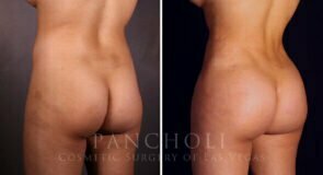 liposuction-brazillian-butt-lift-21357-ldc