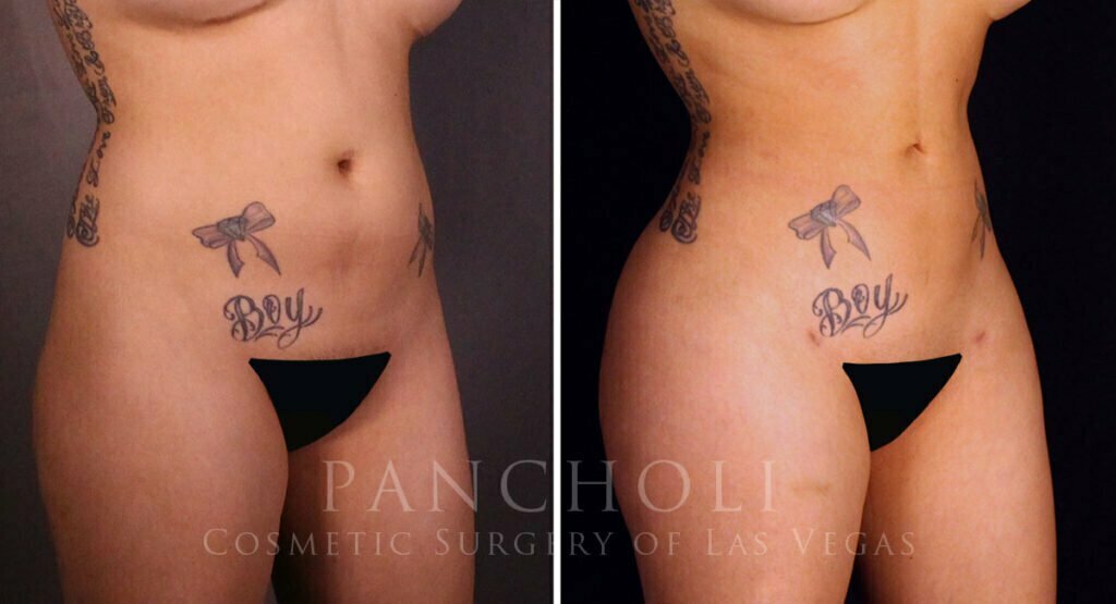 liposuction-brazillian-butt-lift-21357-rb