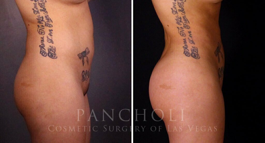 liposuction-brazillian-butt-lift-21357-rc