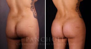 liposuction-brazillian-butt-lift-21357-rdc