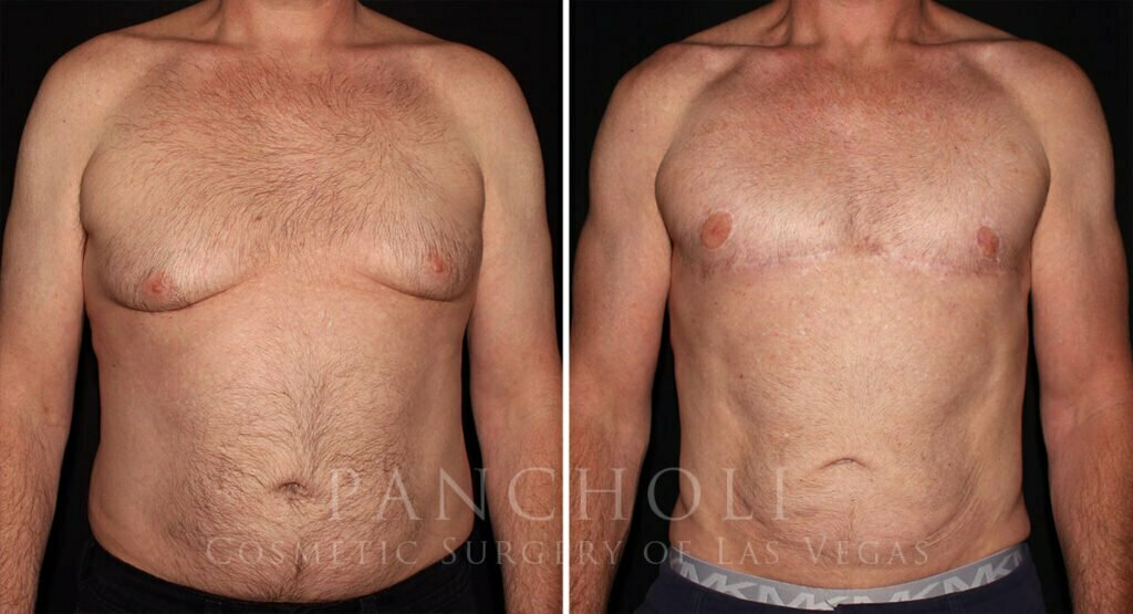 Male Breast Reduction and Liposuction