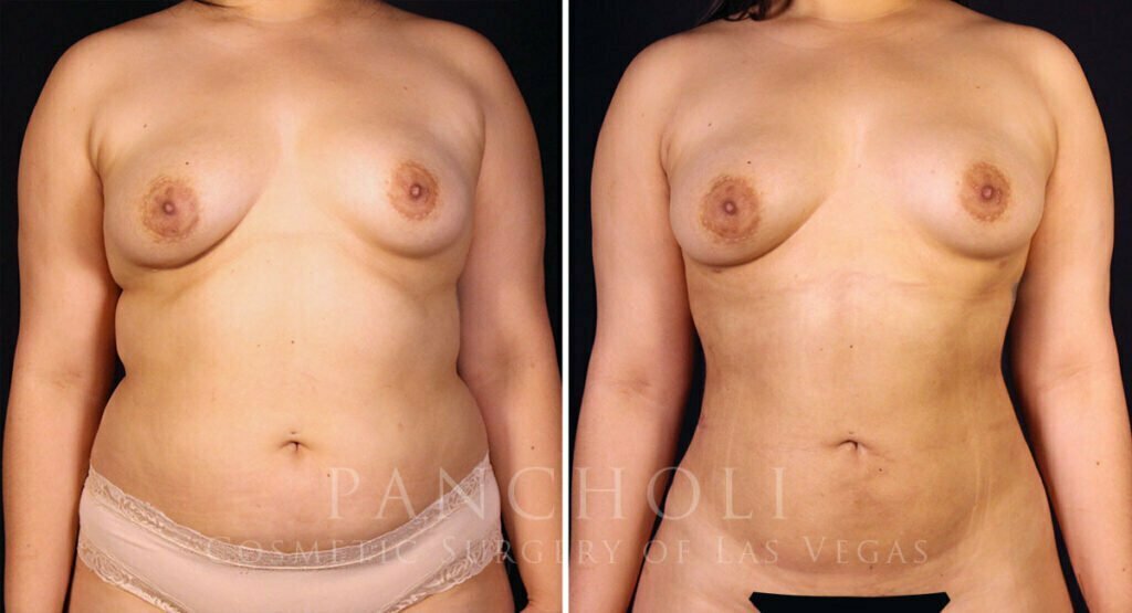 liposuction-21616-a-pancholi
