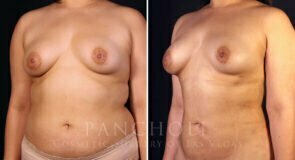 liposuction-21616-lb-pancholi