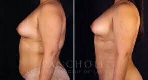 liposuction-21616-lc-pancholi