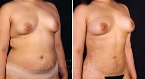 liposuction-21616-rb-pancholi