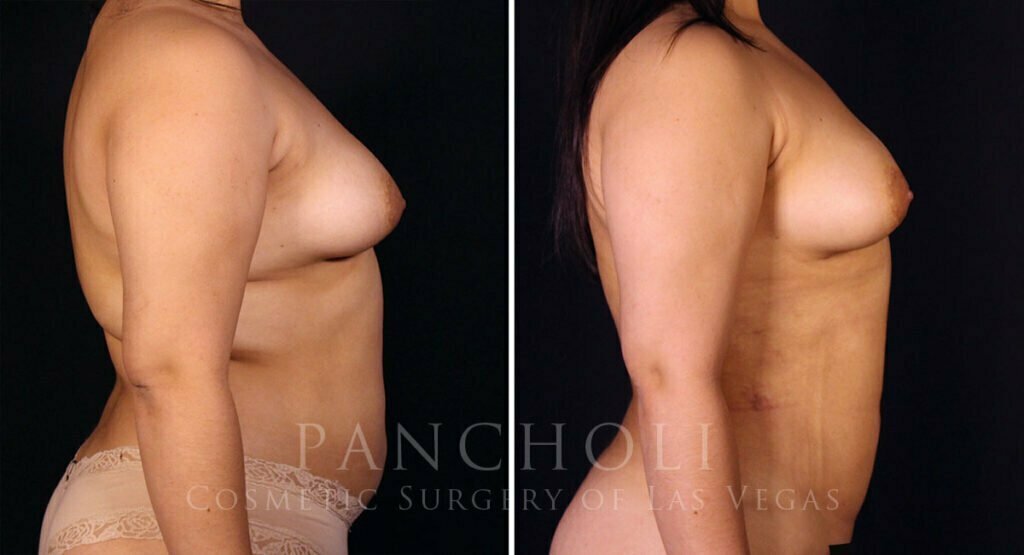 liposuction-21616-rc-pancholi