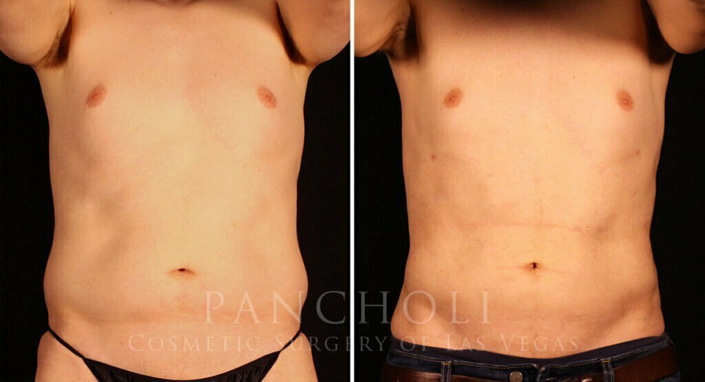 liposuction-21638-a-pancholi