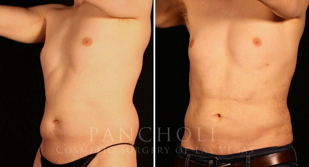 liposuction-21638-lb-pancholi