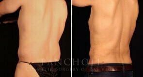 liposuction-21638-ld-pancholi