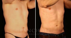 liposuction-21638-rb-pancholi
