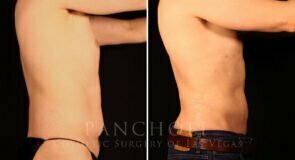 liposuction-21638-rc-pancholi