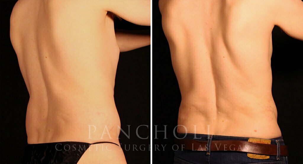 liposuction-21638-rd-pancholi