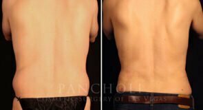 liposuction-21638-rear-pancholi