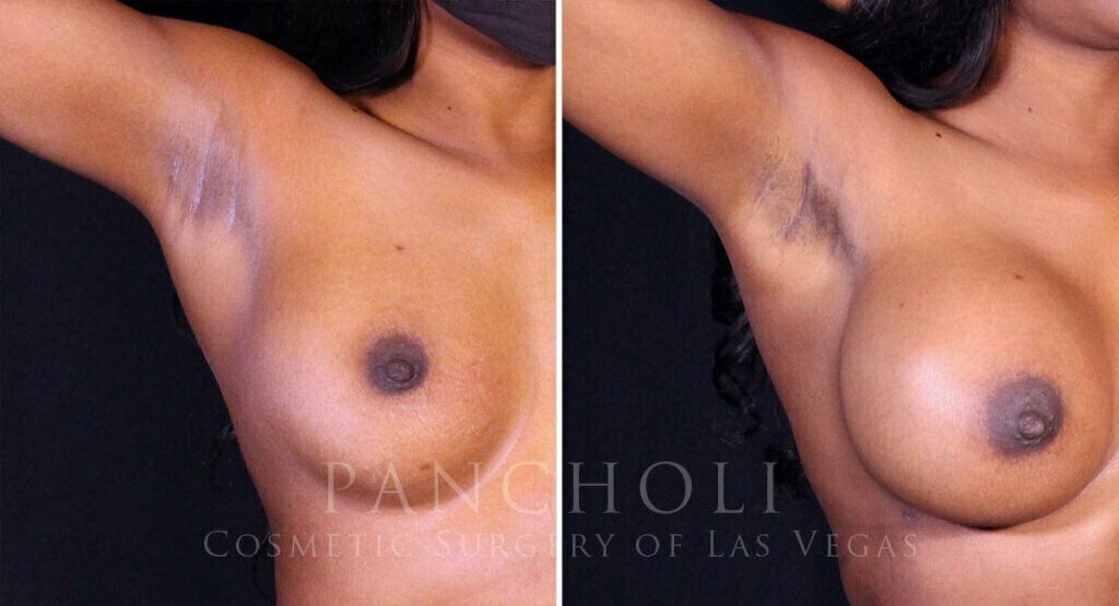 breast-augmentation-liposuction-21756-21726-i