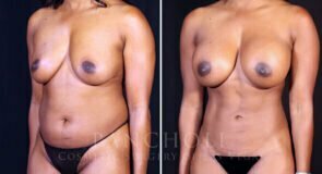 breast-augmentation-liposuction-21756-21726-lb