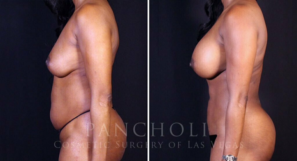 breast-augmentation-liposuction-21756-21726-lc