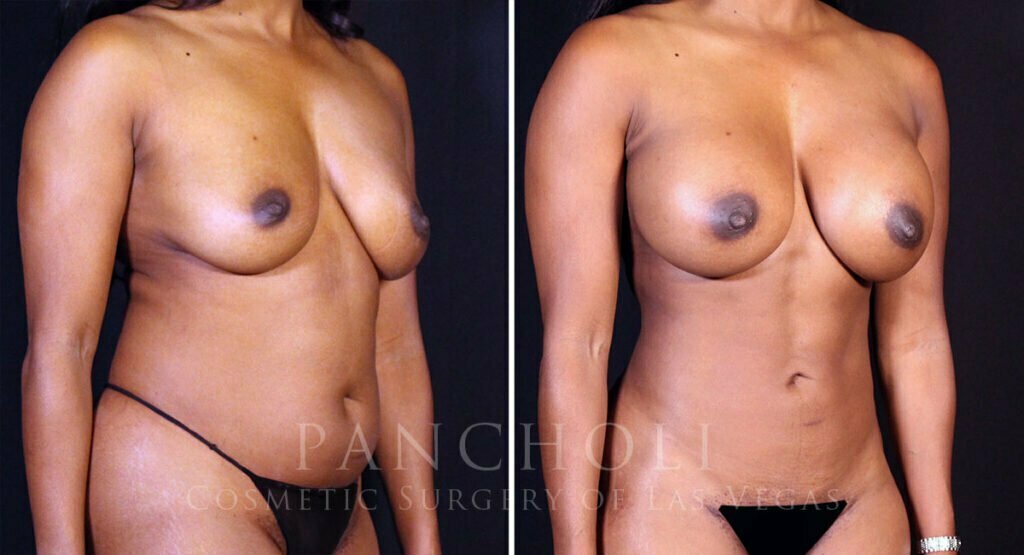 breast-augmentation-liposuction-21756-21726-rb