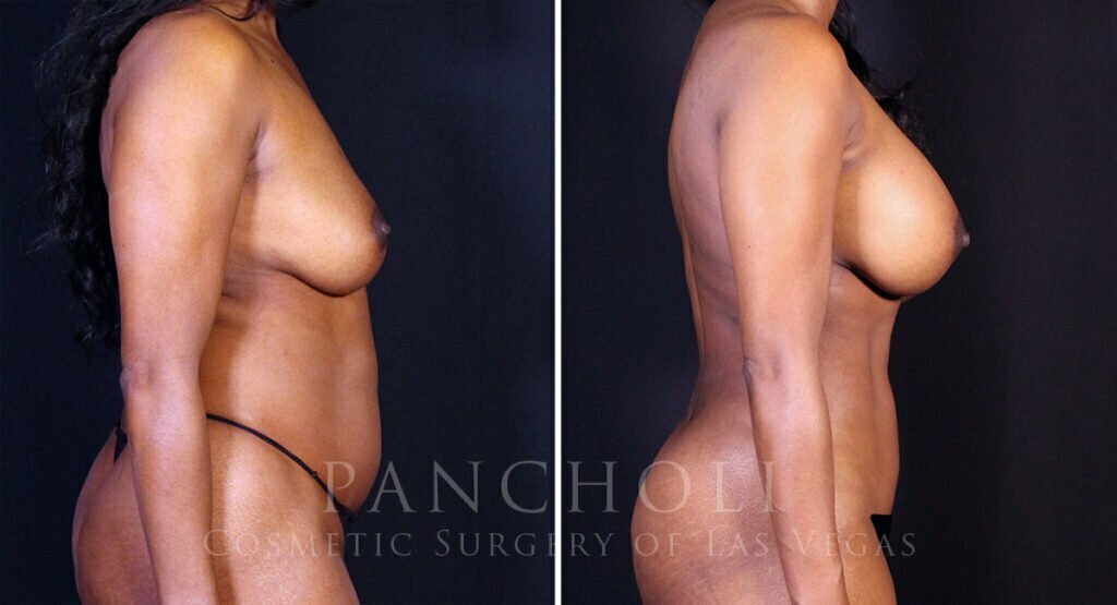 breast-augmentation-liposuction-21756-21726-rc