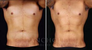 liposuction-vaser-male-21774-a