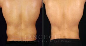 liposuction-vaser-male-21774-d