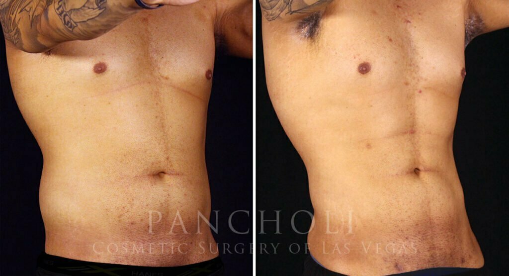 liposuction-vaser-male-21774-rb