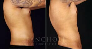 liposuction-vaser-male-21774-rc