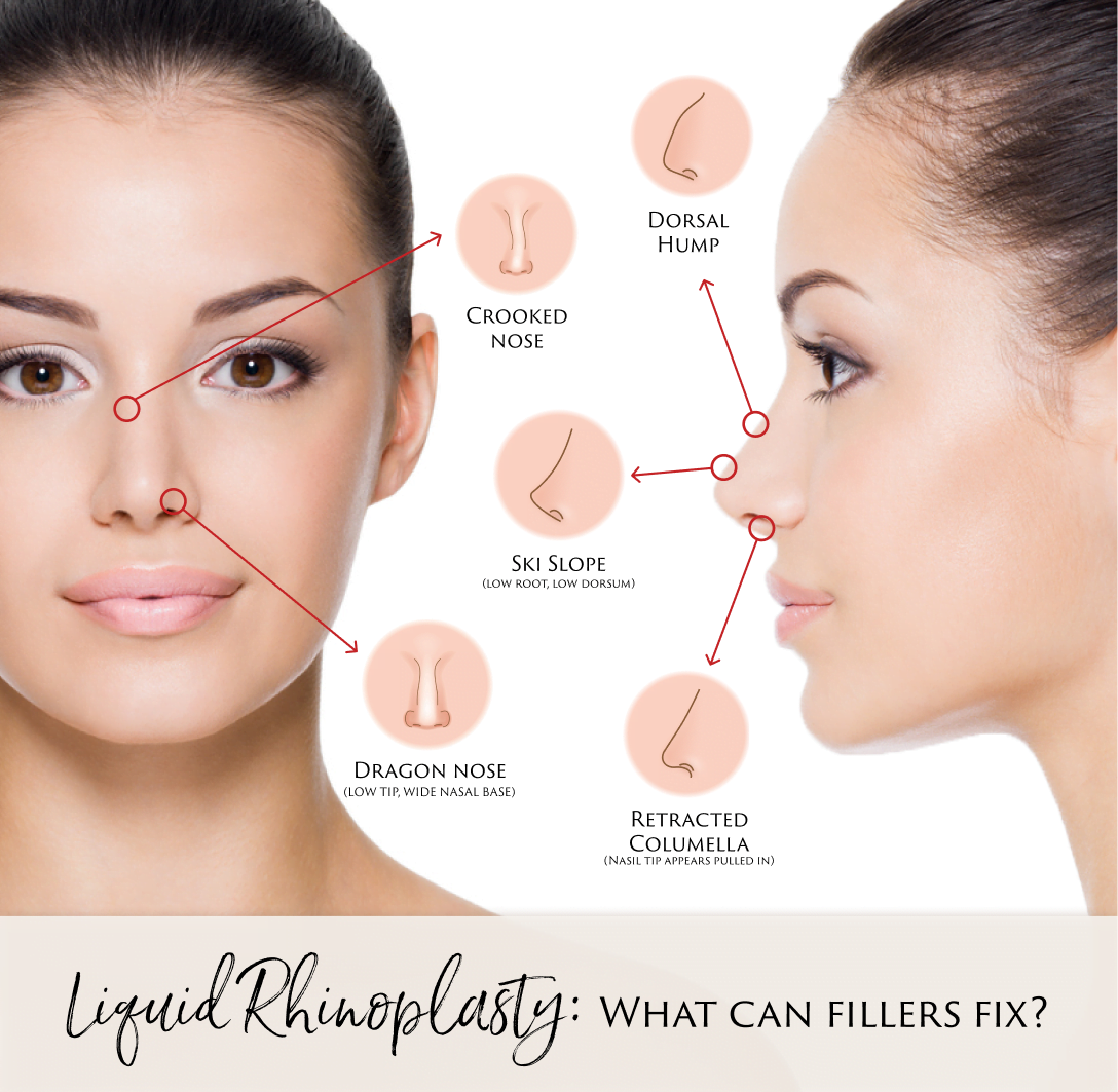 Dr. Pancholi Non-Surgical Rhinoplasty Infographic