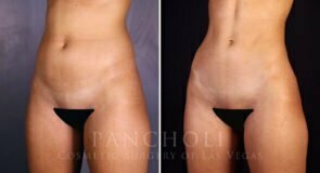 liposuction-21799-lb