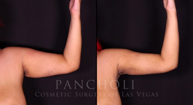 Vaser Liposuction Before and After Gallery