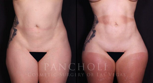 Liposuction Before and After Gallery