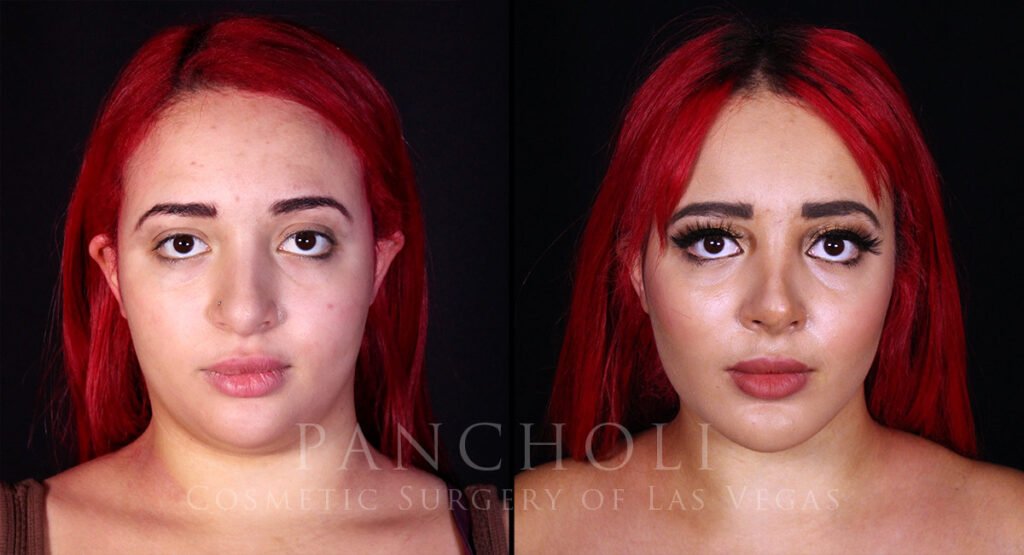 Photo of patient Before (left) and After (right) submentoplasty, buccal fat removal, and rhinoplasty.