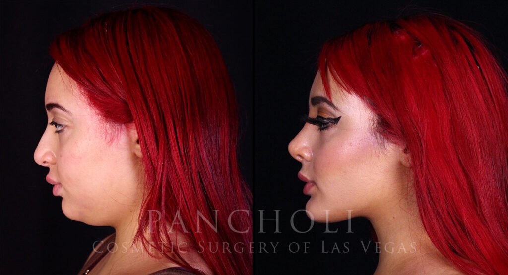 Side profile photo of patient Before (left) and After (right) submentoplasty, buccal fat removal, and rhinoplasty. 