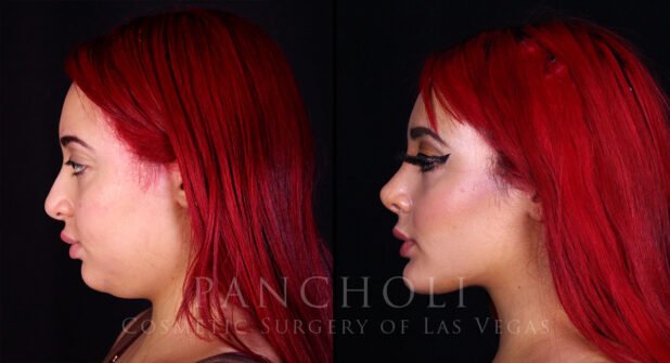 Rhinoplasty Before and After Gallery