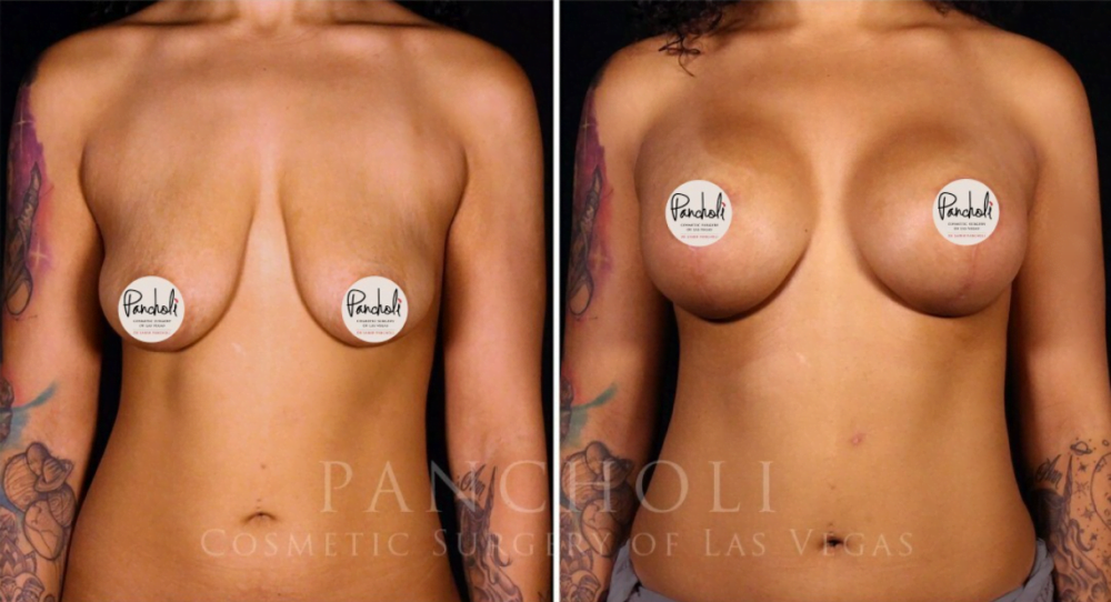 Breast augmentation with lift by Las Vegas cosmetic surgeon Dr. Samir Pancholi