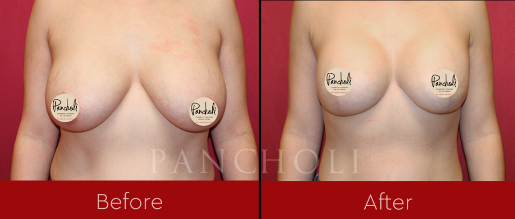 Breast lift with implants by Las Vegas cosmetic surgeon Dr. Samir Pancholi