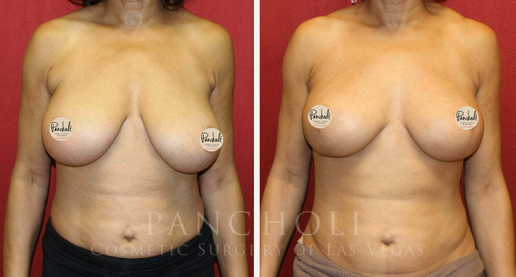 Breast lift performed by Las Vegas cosmetic surgeon Dr. Samir Pancholi