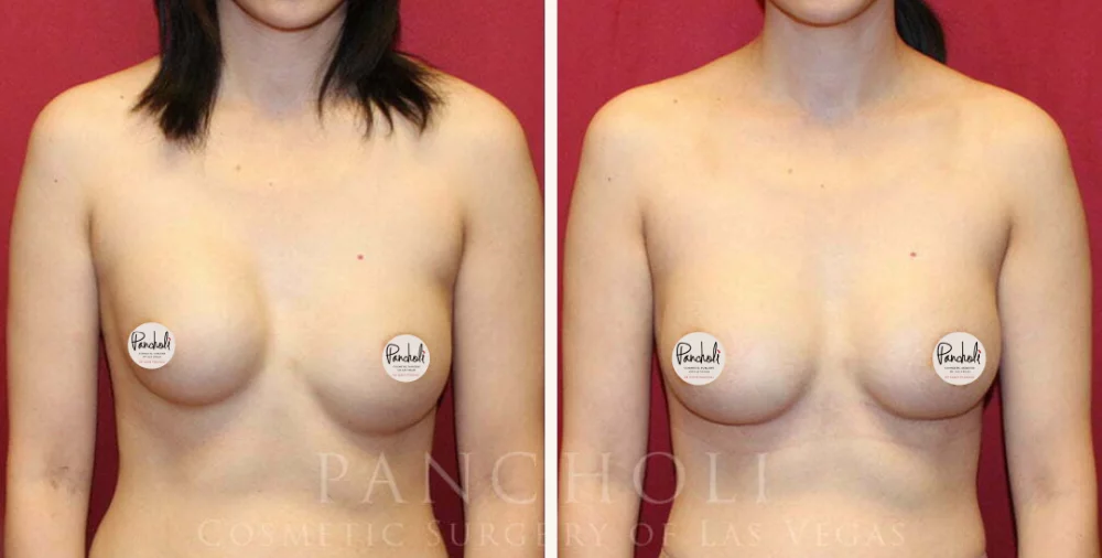 Breast implant revision by Las Vegas cosmetic surgeon Dr. Samir Pancholi