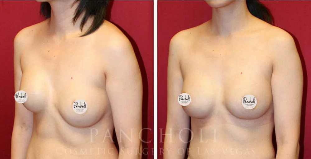 Breast implant revision by Las Vegas cosmetic surgeon Dr. Samir Pancholi