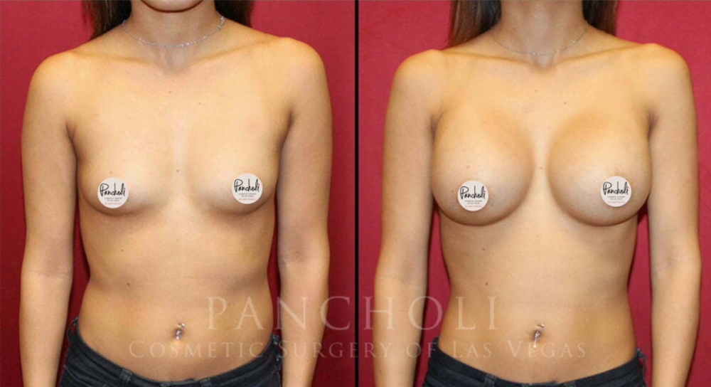 Patient of Las Vegas cosmetic surgeon Dr. Samir Pancholi shown before and after breast augmentation