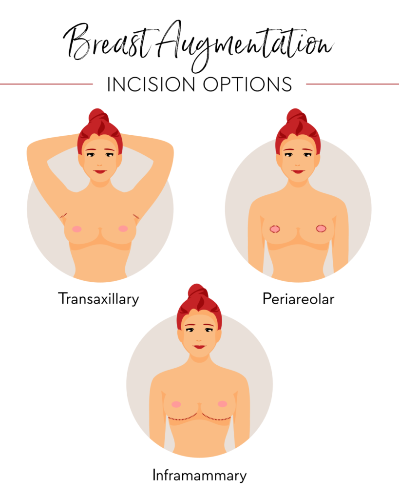 Breast augmentation incision options